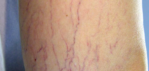 علاج الدوالي