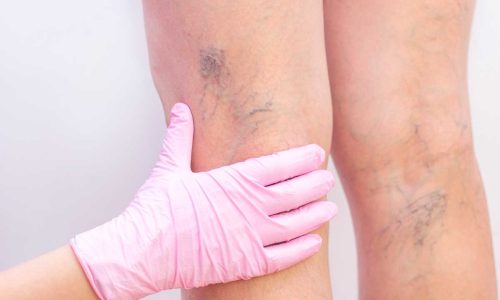 أفضل علاج للدوالي – حلول ونصائح علمية