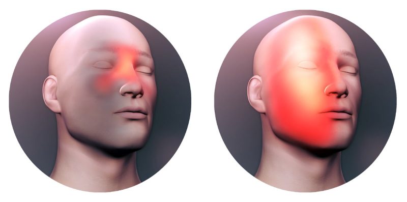 اعراض الجيوب الأنفية